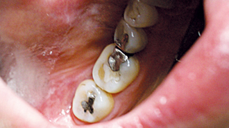 Vplyv abrazivity zubných pást na tvrdé zubné tkanivá