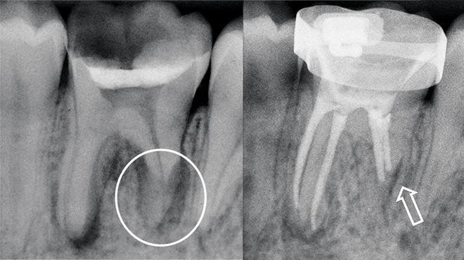 Endodontické ošetření zubu s nekrózou pulpy a rozsáhlou zánětlivou vnější apikální resorpcí v jedné návštěvě: Je to možné?