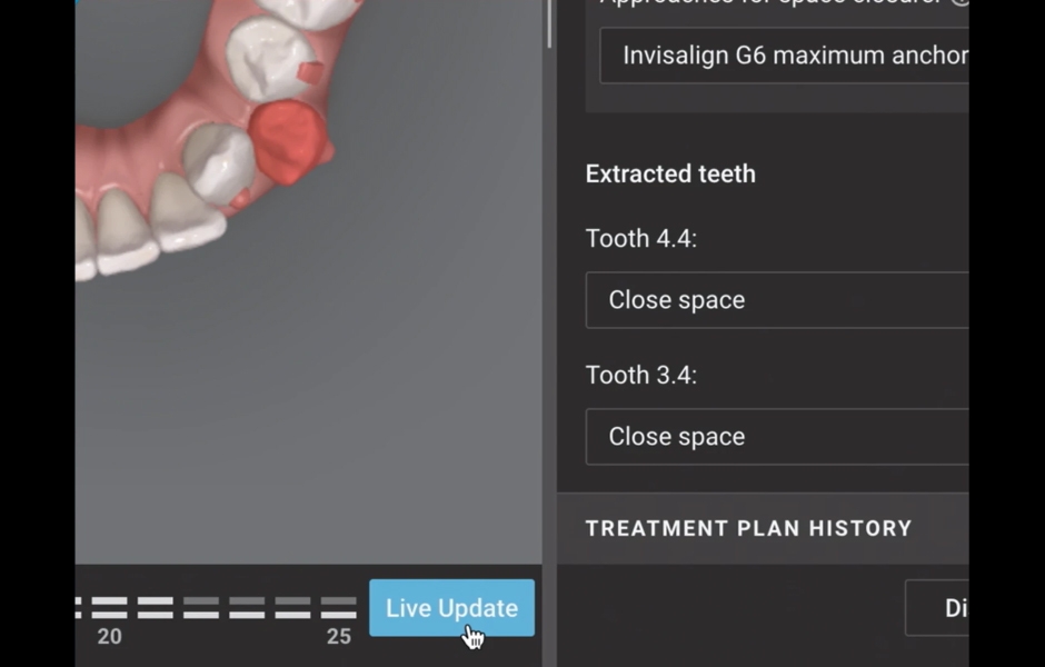Obr. 5: ClinCheck Live Update poskytuje okamžitou vizuální zpětnou vazbu o pohybu zubů, čímž zlepšuje spolupráci a klinickou efektivitu.