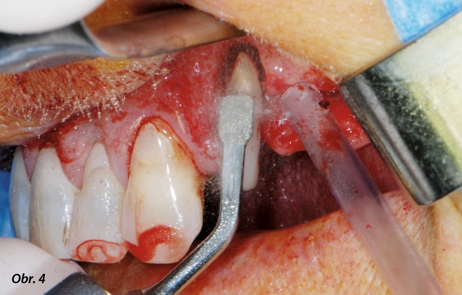 Aby bylo možné zachovat zub jako dočasný pilíř, bylo jeho periodoncium očištěno piezoelektrickým zařízením…