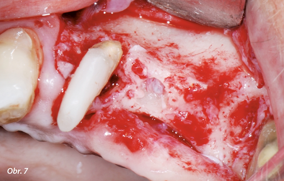 Po očištění byly zřetelně vidět kostní defekty meziálně vůči zubu 27 a kolem kořene zubu 24.