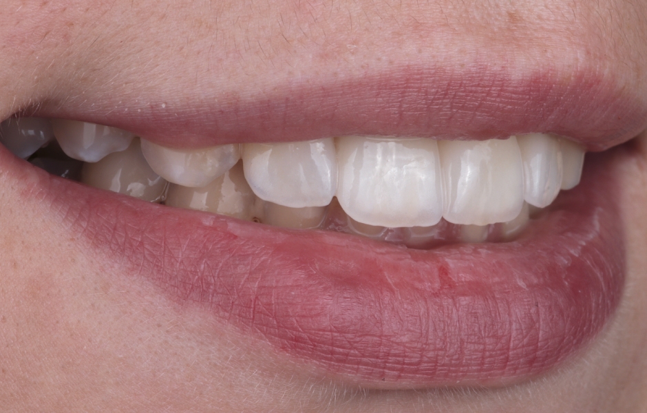 Obr. 10: Pohled na rty po nasazení fazet.