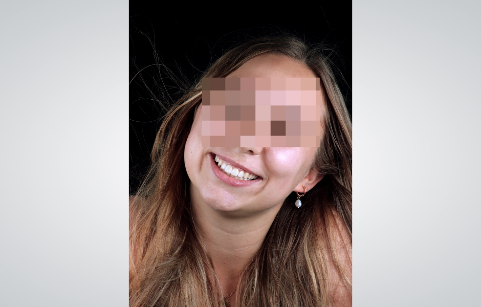 Obr. 13: Upřímný a autentický úsměv pacientky na konci léčby.