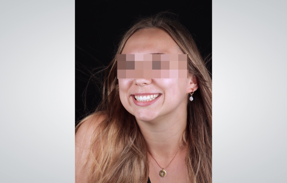 Obr. 14: Upřímný a autentický úsměv pacientky na konci léčby.