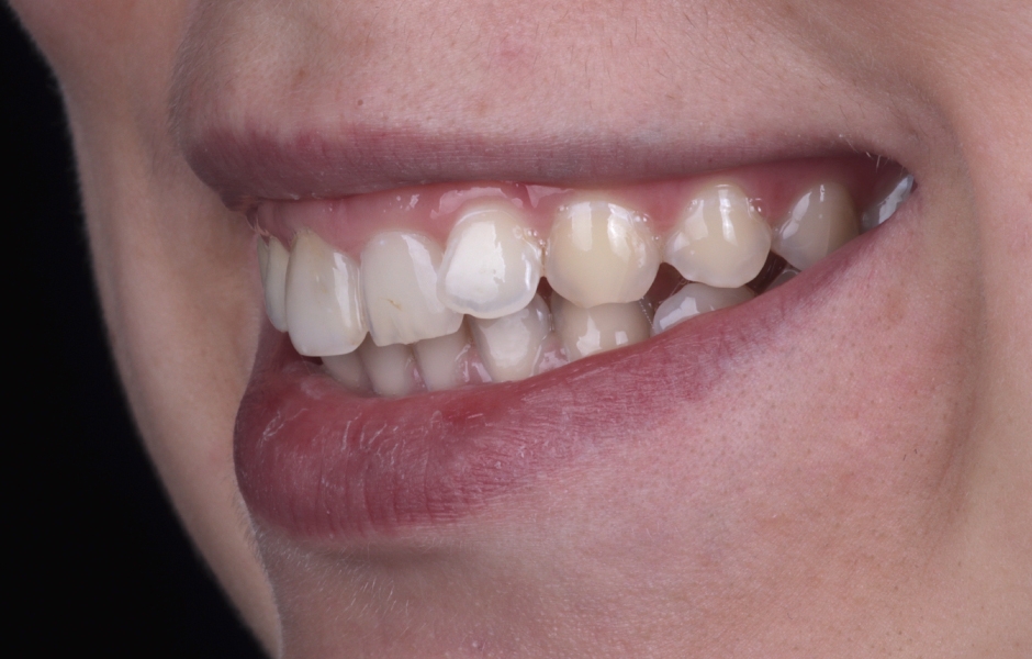 Obr. 2: Výchozí situace – boční pohled.