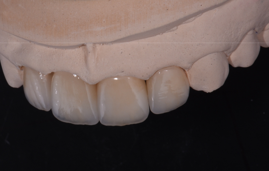Obr. 8: Fazety (Initial LiSi Press) s individuálním vrstvením (Initial LiSi) na modelu.