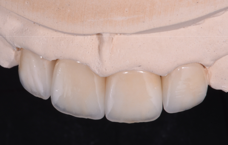 Obr. 9: Fazety (Initial LiSi Press) s individuálním vrstvením (Initial LiSi) na modelu.