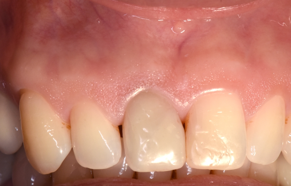 Obr. 1.5: Odstranění sutur po 48 hodinách a kontrola po třech letech – kompletní absence jizvy.