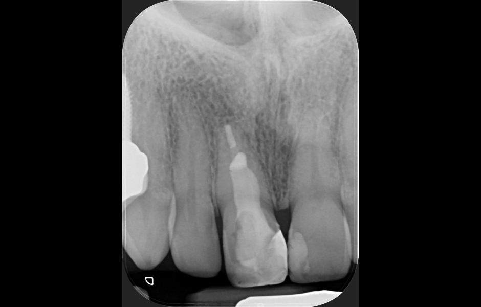 Obr. 1.6: Kontrola po třech letech.