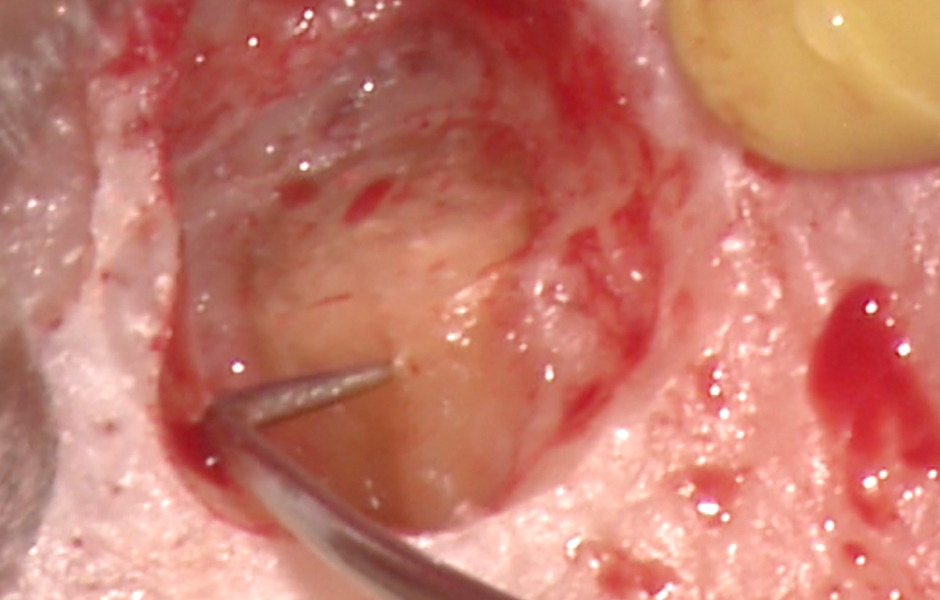 Obr. 2.4: Zavedení sondy do ústí laterálního kanálku odpovědného za laterální lézi.