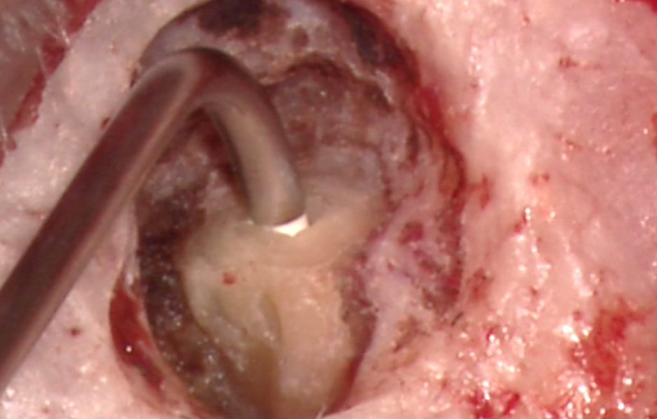 Obr. 2.6: Zavádění retrográdního výplňového materiálu do apikální preparace.