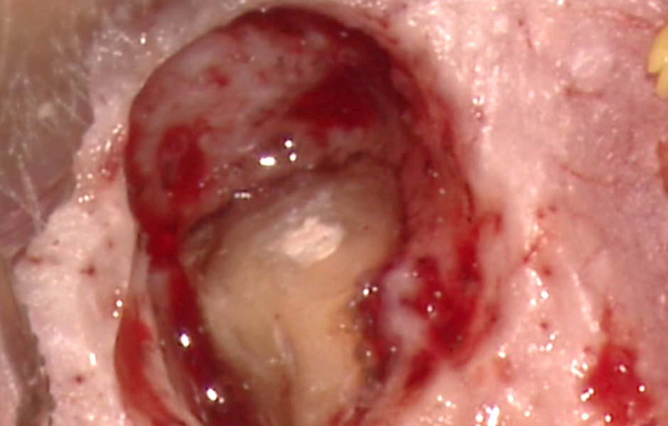 Obr. 2.7: Apikální i laterální preparace vyplněny bílým MTA.