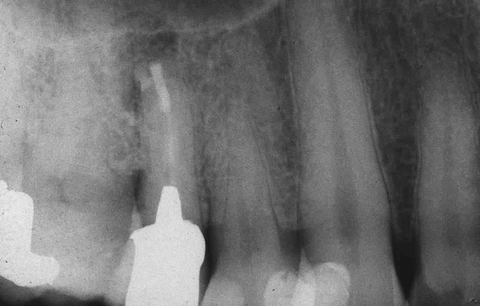 Obr. 2.8: Pooperační rentgenový snímek zobrazující obě retrográdní výplně.