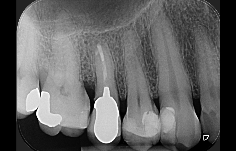 Obr. 2.9: Kontrola po třech letech s kompletním zhojením obou lézí.