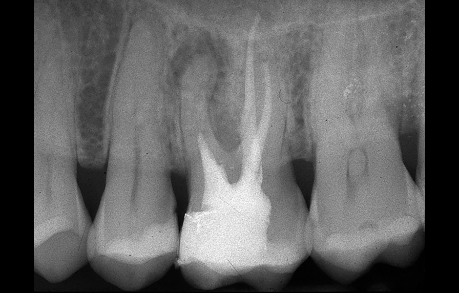 Obr. 4.1: Předoperační snímek horního levého prvního moláru. Oba kanálky mesiobukálního kořene byly kompletně kalcifikované a nebylo možné je ortográdně zprůchodnit.