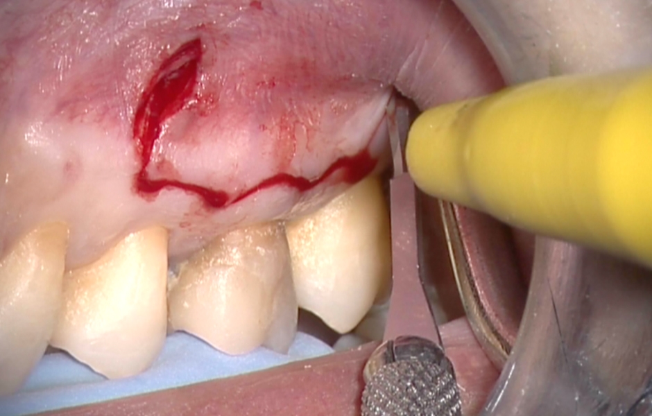 Obr. 4.2: Submarginální lalok.