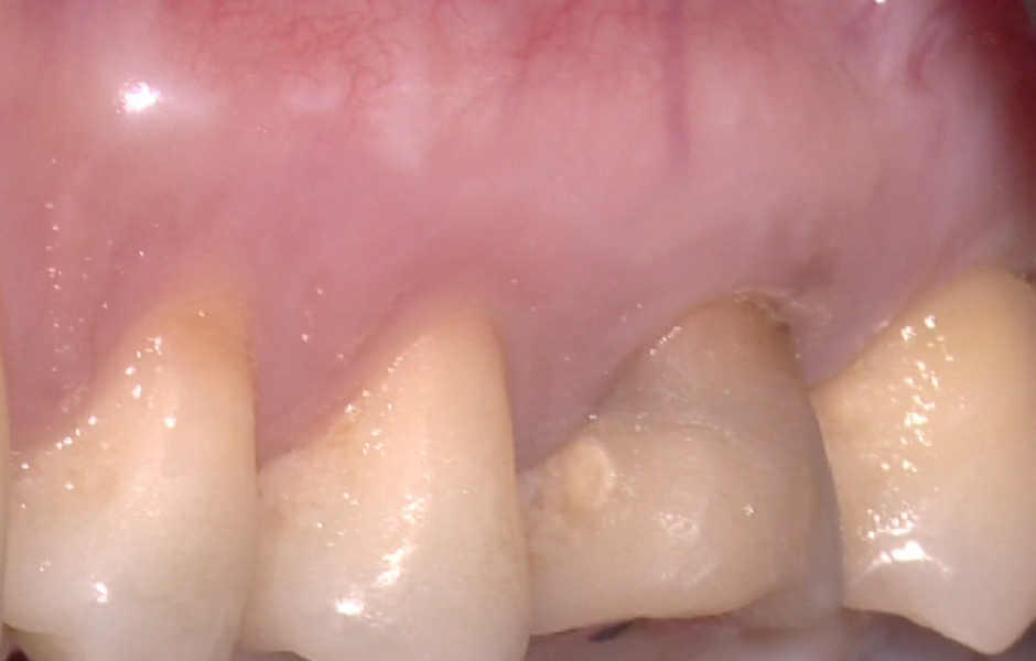 Obr. 4.7: Odstranění sutur po 48 hodinách a kontrola po třech letech prokazující kompletní absenci jizvy.