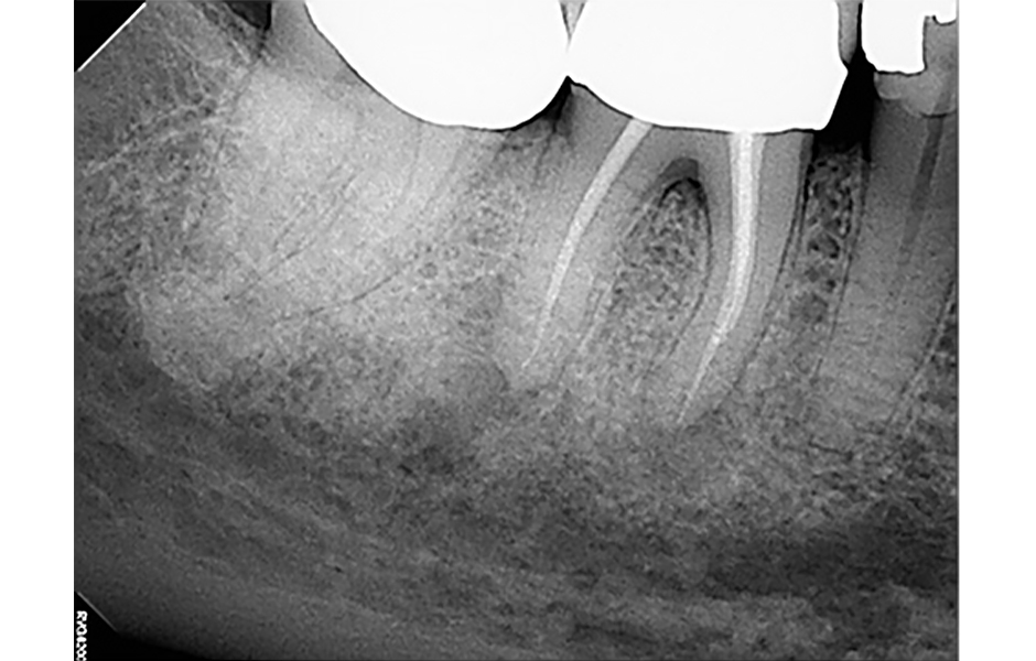Obr. 1: Předoperační PA rentgenový snímek zubu 46.