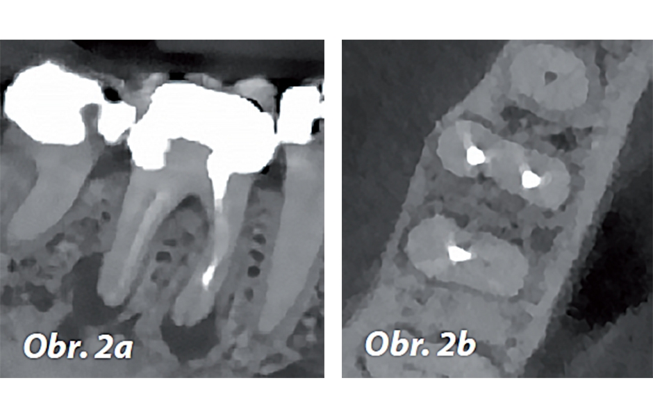 Obr. 2a, b: Předoperační CBCT řezy zubu 46 – a) sagitální, b) axiální.