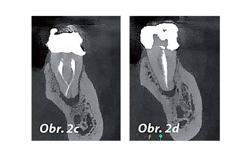 Obr. 2c, d: Předoperační CBCT řezy zubu 46 – c) meziální kořen, d) distální kořen.