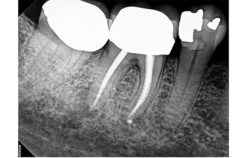 Obr. 3: Pooperační periapikální rentgenový snímek zubu 46 bezprostředně po reendodontickém ošetření v červnu 2022.