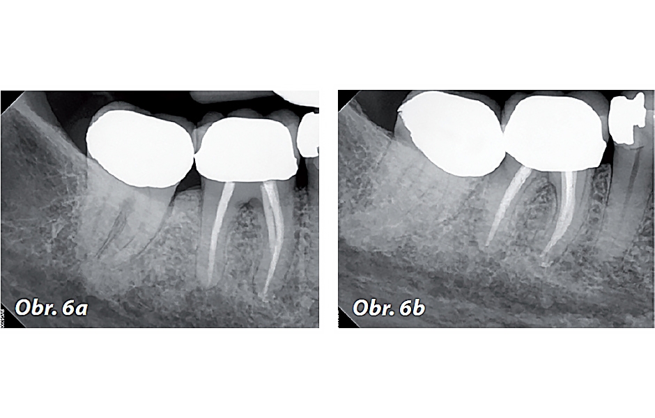 Obr. 6a, b: Kontrolní PA rentgenové snímky zubu 46 v červnu roku 2023.