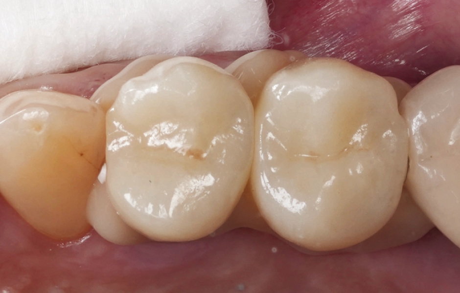 Obr. 10: Za těchto podmínek bylo možné provést řádnou cementaci definitivní rekonstrukce.
