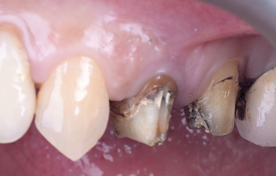 Obr. 2: Klinická situace po sejmutí korunek ze zubů 24 a 25.