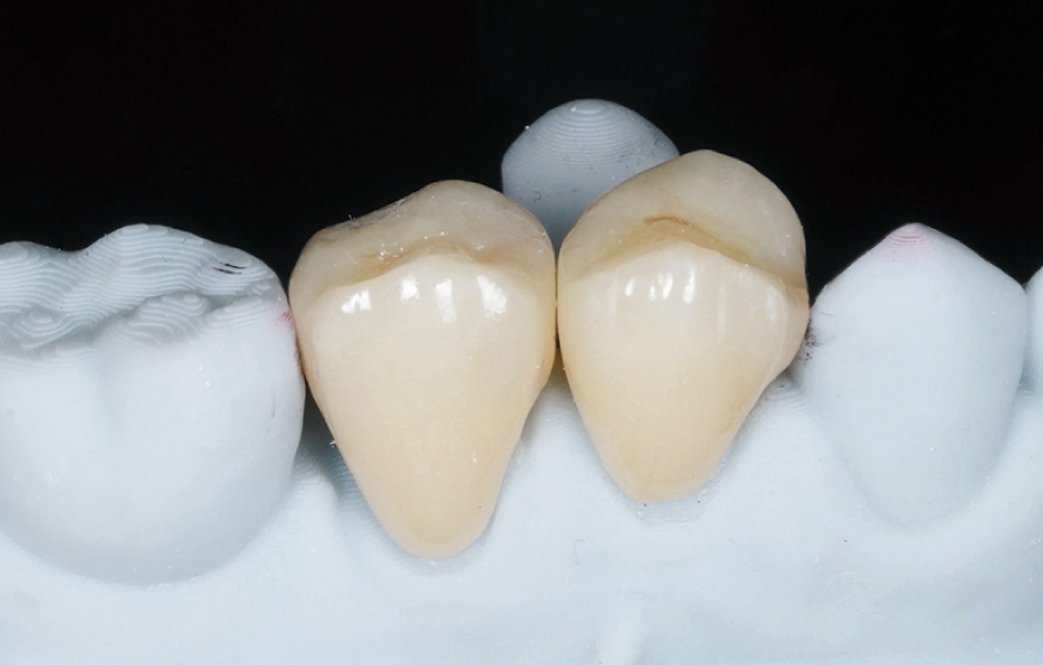 Obr. 6: Zhotovení definitivní protetické rekonstrukce v laboratoři.