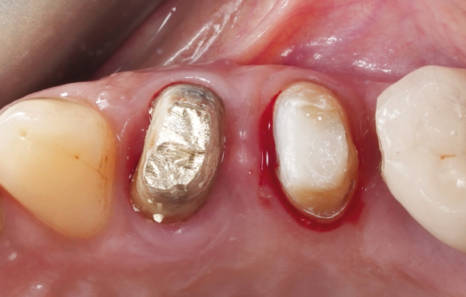 Obr. 7: Klinická situace po sejmutí provizorních náhrad při definitivním ošetření.