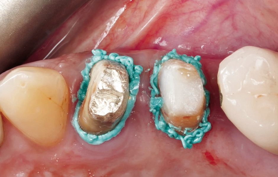 Obr. 8: Přípravek RetraXil byl aplikován po dobu 2 minut ke kontrole krvácení před cementací.