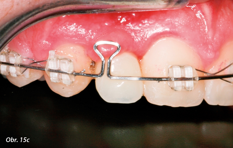 Ortodontické uzavření mezery: c) po 3 týdnech