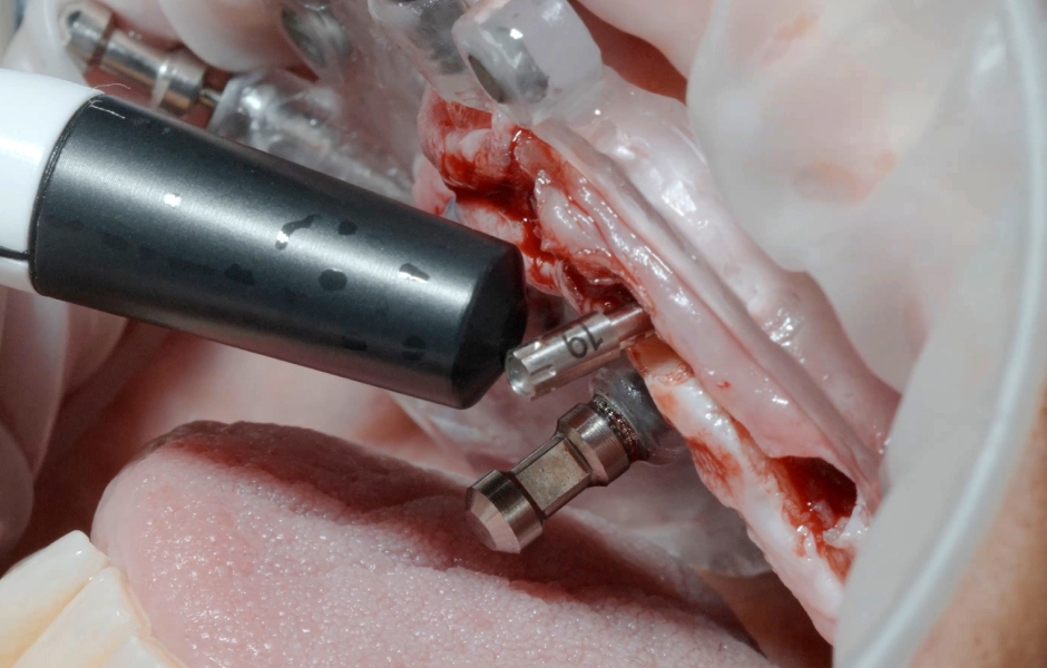 Obr. 16: Bezkontaktní RFA měření stability implantátu (ISQ) pomocí Penguin II (bredent medical).