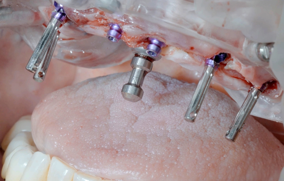 Obr. 18: Kontrola paralelity pomocí zaváděcího nástroje.