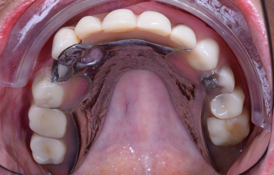 Obr. 2: Klinická a radiologická výchozí situace v horní čelisti se selhávajícími předchozími rekonstrukcemi.