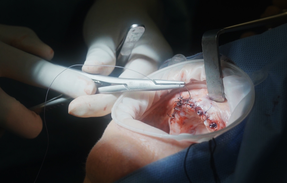 Obr. 20: Těsný uzávěr sliznice v oblasti abutmentů SKY uni.cone.