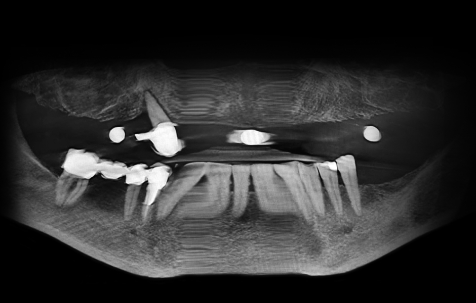 Obr. 4: Klinická a radiologická výchozí situace v horní čelisti se selhávajícími předchozími rekonstrukcemi.