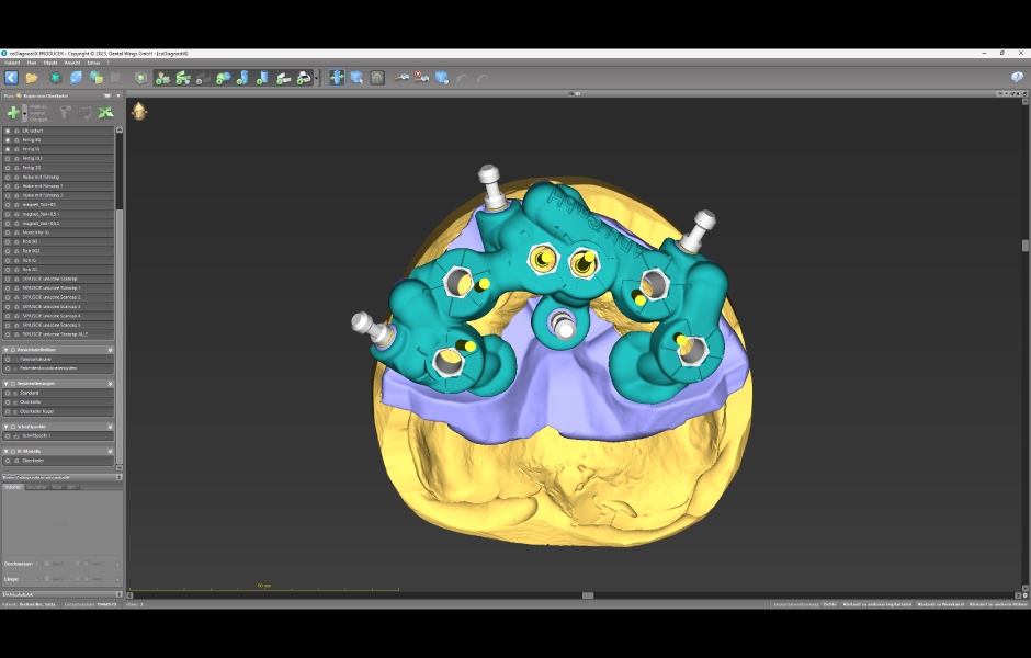 Obr. 6: Návrh a výroba modulární chirurgické šablony s okluzálně-palatinálními vstupy pro šrouby.