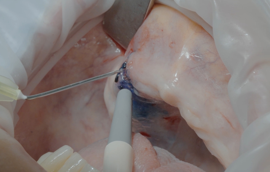 Obr. 9: Aplikace a aktivace Helbo (bredent medical).