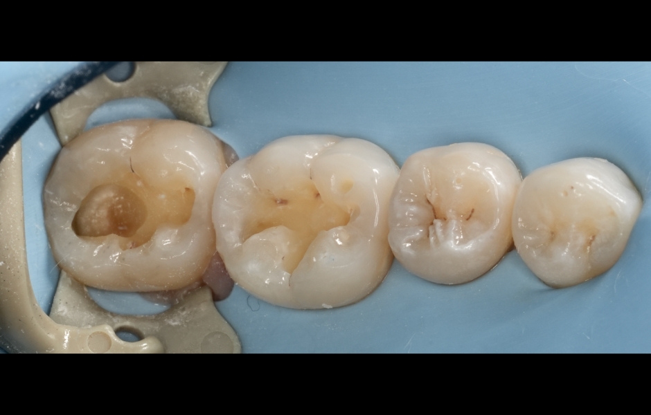 Obr. 1b: Izolace kofferdamem a preparace kavity I. třídy. Odstranění kazu na sklovino-dentinové hranici kombinací tvrdokovových fréz a air-abraze (Al₂O₃ 29 μm, 3 bar).