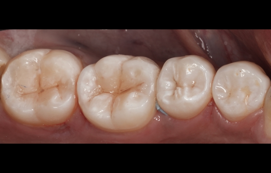 Obr. 1c: Bezprostřední pooperační výsledek: kompozitní rekonstrukce I. třídy na zubech 36 a 37 (GrandioSO Unlimited, cluster A2) s charakterizací FinalTouch brown/white.