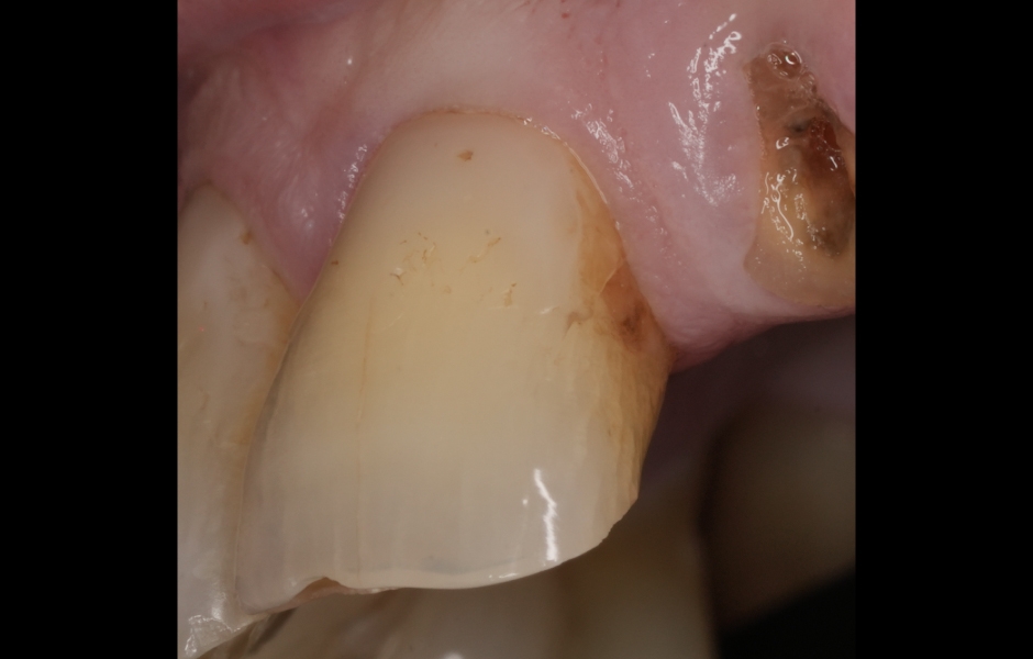Obr. 3a: Klinické známky sekundárního kazu na zubu 21.