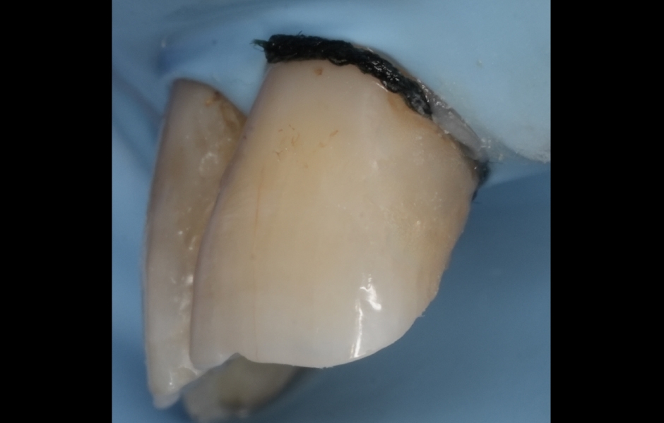 Obr. 3c: Bezprostřední pooperační výsledek rekonstrukce zubu 21 (GrandioSO Unlimited, cluster A3).