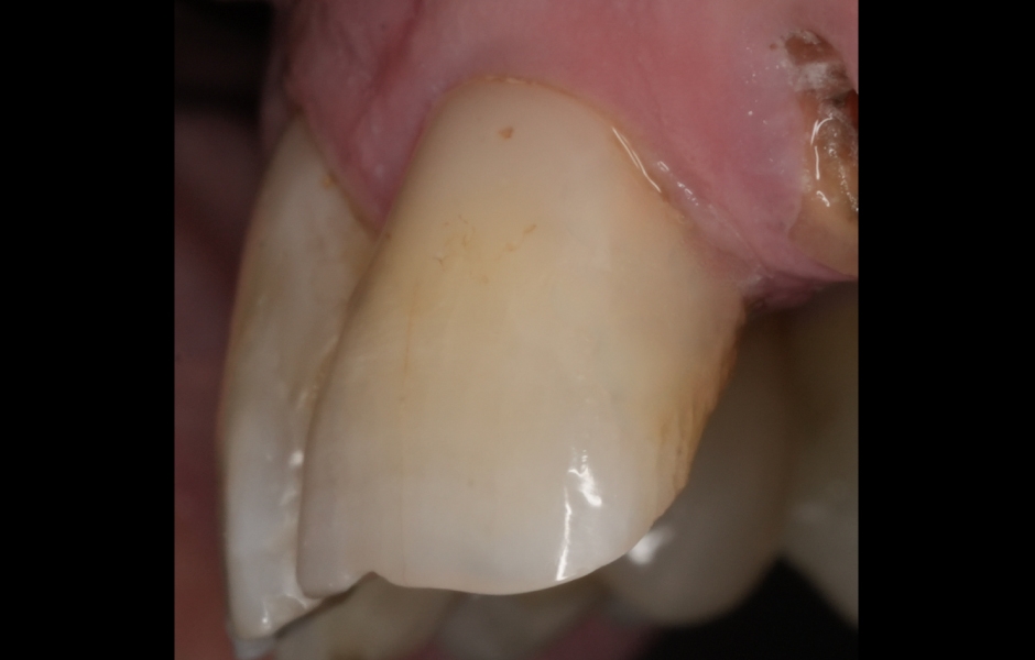 Obr. 3d: Rekonstrukce zubu 21 po dokončení leštění a odstranění kofferdamu.