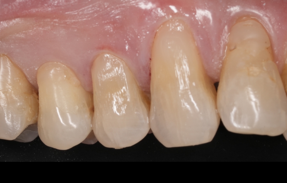 Obr. 4c: Předoperační posouzení odstínu: mock-up GrandioSO Unlimited A3.5 po vytvrzení.