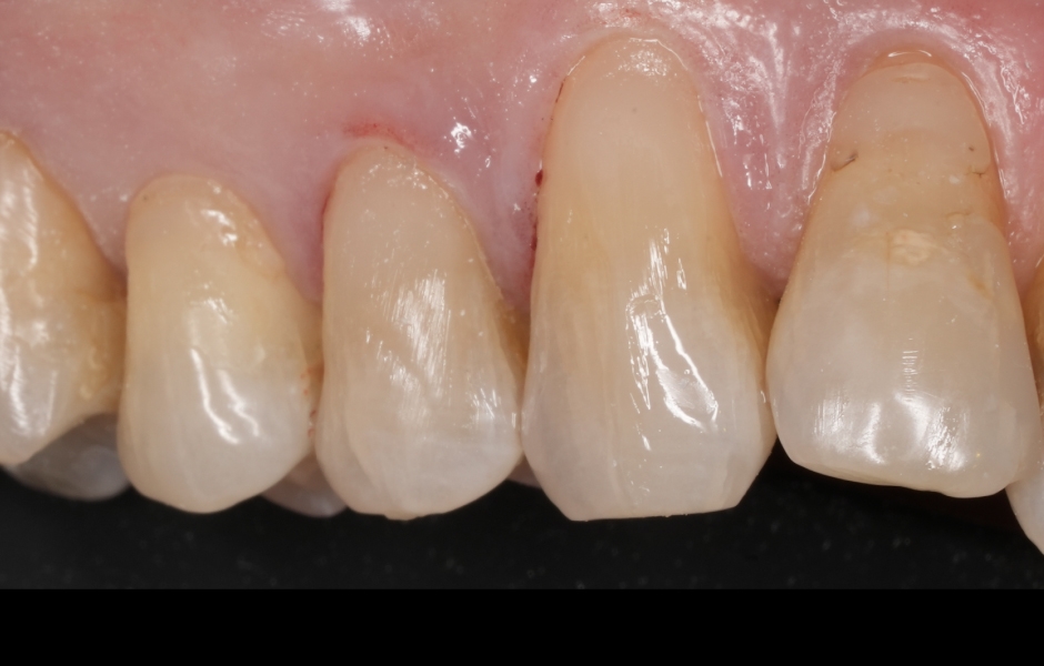 Obr. 4d: Po anestezii následuje odstranění kompozita 13 a 14 a aplikace GrandioSO Unlimited (cluster A3.5), finální vytvrzení a iniciální leštění.