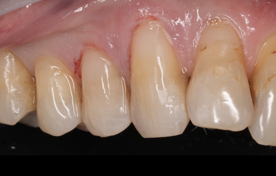 Obr. 4e: Bezprostřední pooperační pohled po finálním leštění na zubech 13 a 14.