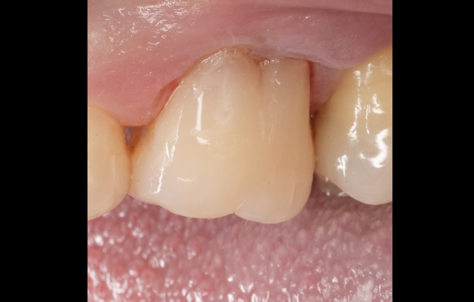 Obr. 5d: Zub 26 (cluster A3) – hotová výplň na zubu – bukální pohled.
