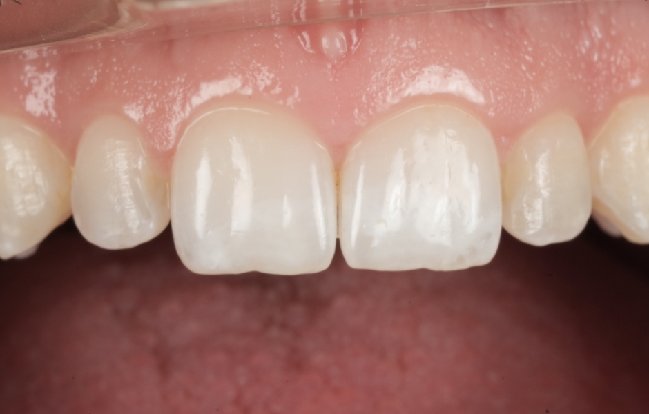 Obr. 6b: Předoperační detail.