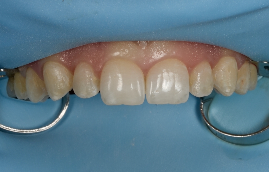 Obr. 6c: Předoperační úsměv (split-dam ve frontálním úseku).